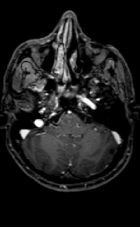 Neuro-Behçet disease (Radiopaedia 90112-107294 Axial T1 C+ 175).jpg