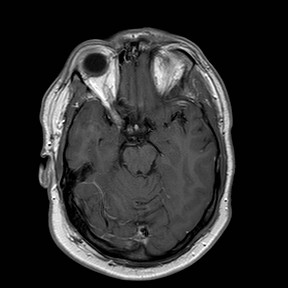 File:Neuro-Behcet's disease (Radiopaedia 21557-21506 Axial T1 C+ 11).jpg