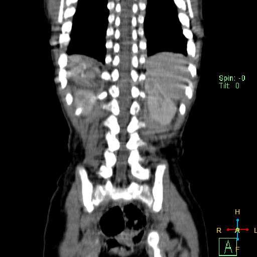 File:Neuroblastoma (Radiopaedia 24751-25016 B 21).jpg