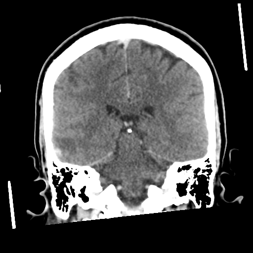 Neurocysticercosis - granular nodular (Radiopaedia 42786-45957 Coronal C+ 41).png