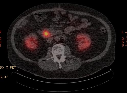 File:Neuroendocrine tumor- pancreas (Radiopaedia 11670-32204 PET-CT 1).jpg