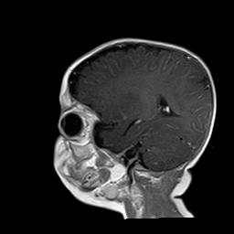 File:Neurofibromatosis type 1 (Radiopaedia 30089-30671 Sagittal T1 C+ 14).jpg
