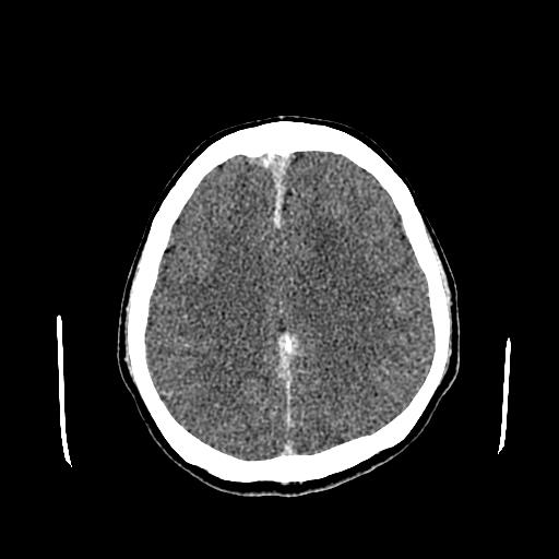 File:Neurofibromatosis type 2 (Radiopaedia 25389-25637 Axial C+ 65).jpg
