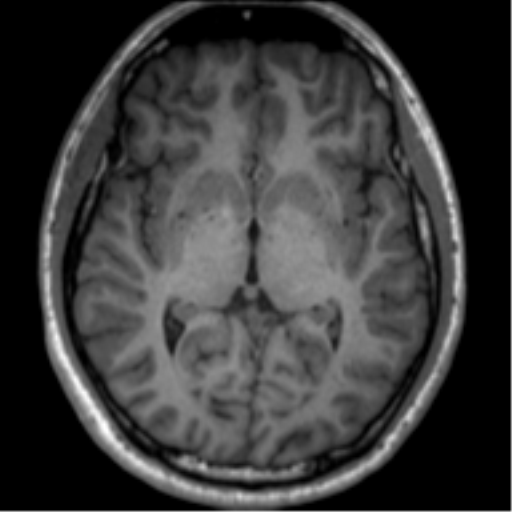 File:Neurofibromatosis type 2 (Radiopaedia 44936-48838 Axial T1 68).png