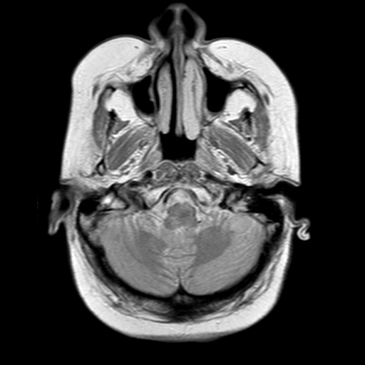 File:Neurofibromatosis type 2 (Radiopaedia 8713-9518 Axial Gradient Echo 21).jpg