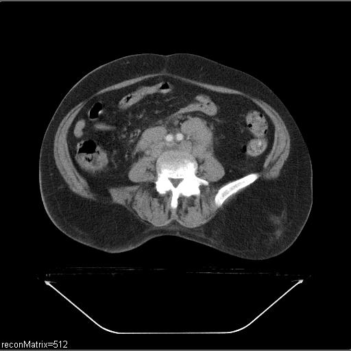 File:Non-Hodgkin lymphoma (Radiopaedia 27492-27690 B 1).jpg