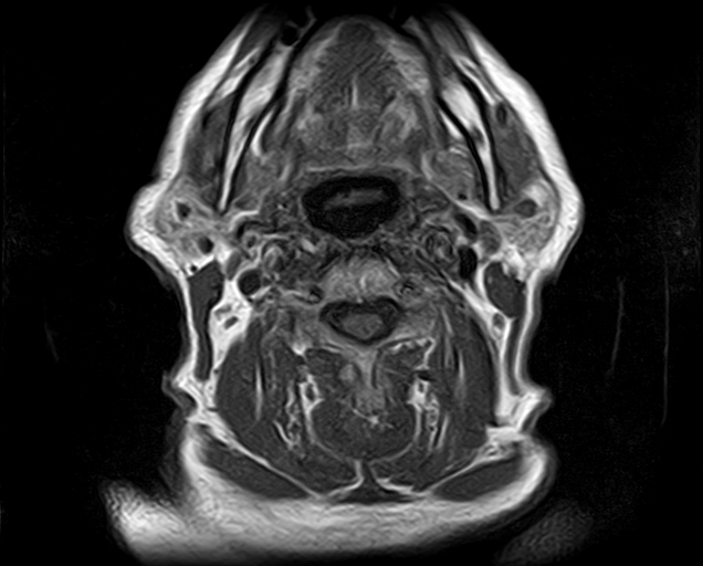 File:Non-Hodgkin lymphoma - parotid gland (Radiopaedia 71531-81890 Axial T1 8).jpg