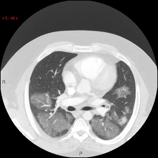 File:Non-specific interstitial pneumonitis (Radiopaedia 27044-27222 Axial lung window 31).jpg