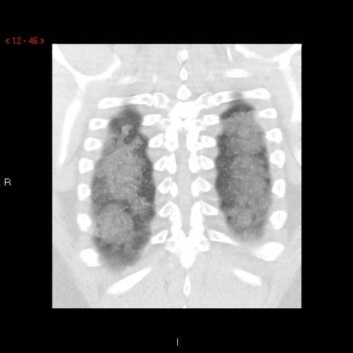 File:Non-specific interstitial pneumonitis (Radiopaedia 27044-27222 Coronal lung window 46).jpg