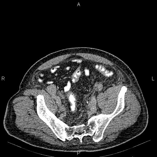 Non Hodgkin lymphoma in a patient with ankylosing spondylitis (Radiopaedia 84323-99621 Axial C+ delayed 64).jpg