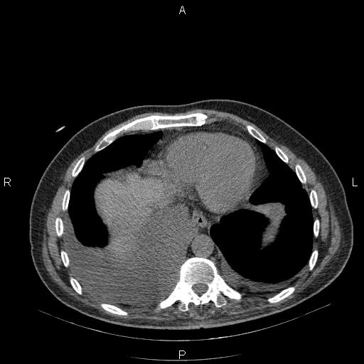 File:Non Hodgkin lymphoma in a patient with ankylosing spondylitis (Radiopaedia 84323-99624 Axial non-contrast 26).jpg