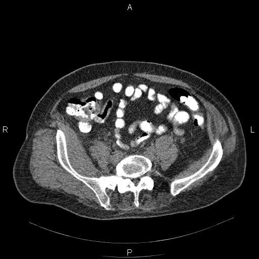 File:Non Hodgkin lymphoma in a patient with ankylosing spondylitis (Radiopaedia 84323-99624 Axial non-contrast 52).jpg