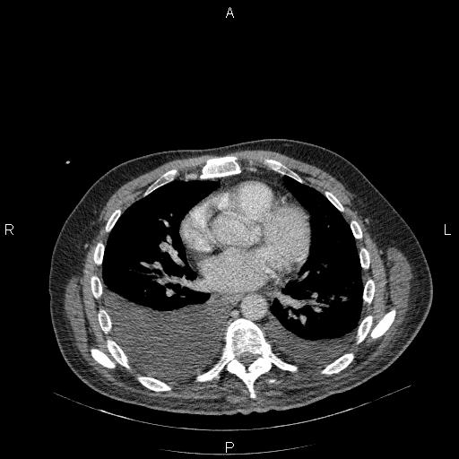 File:Non Hodgkin lymphoma in a patient with ankylosing spondylitis (Radiopaedia 84323-99624 B 17).jpg