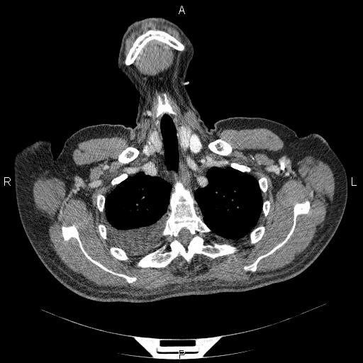 File:Non Hodgkin lymphoma in a patient with ankylosing spondylitis (Radiopaedia 84323-99624 B 6).jpg