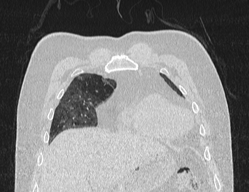 Non specific interstitial pneumonia (NSIP) (Radiopaedia 89725-106798 Coronal lung window 17).jpg
