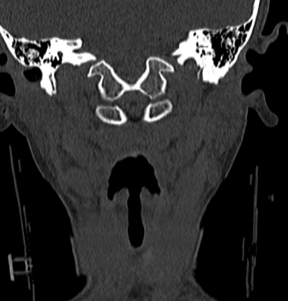 File:Normal CT cervical spine - 12-year-old (Radiopaedia 55352-61775 Coronal bone window 37).jpg