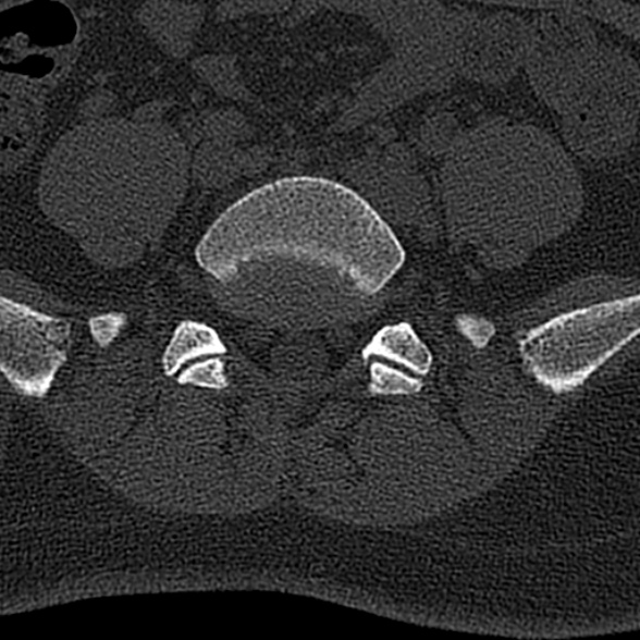 File:Normal CT lumbar spine (Radiopaedia 53981-60118 Axial bone window 62).jpg