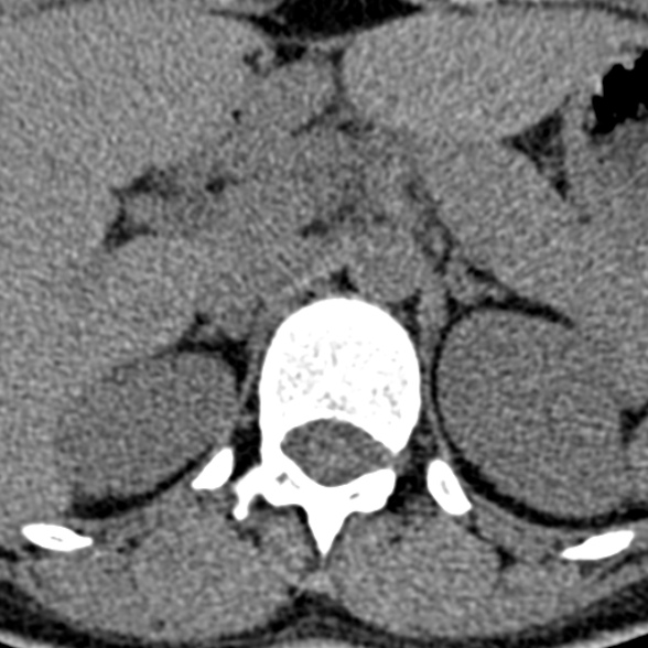 Normal CT lumbar spine (Radiopaedia 53981-60118 Axial non-contrast 6).jpg