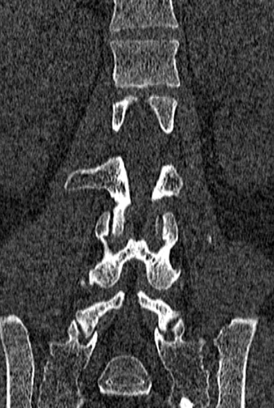 Normal CT lumbar spine (Radiopaedia 53981-60118 Coronal bone window 41).jpg