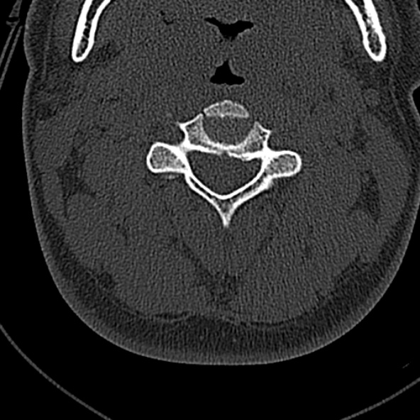 Normal CT of the cervical spine (Radiopaedia 53322-59305 Axial bone window 102).jpg