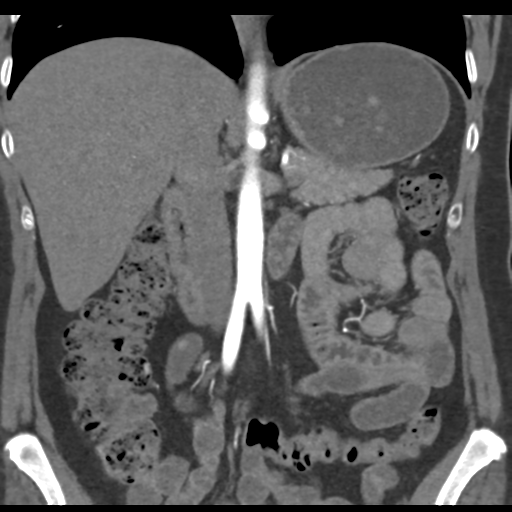 File:Normal CT renal artery angiogram (Radiopaedia 38727-40889 B 38).png