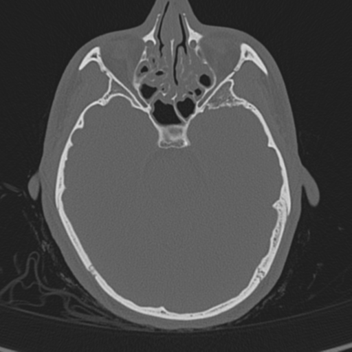 Normal CT skull (Radiopaedia 40798-43459 A 53).png