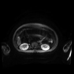 Normal MRI abdomen in pregnancy (Radiopaedia 88001-104541 Axial DWI 75).jpg