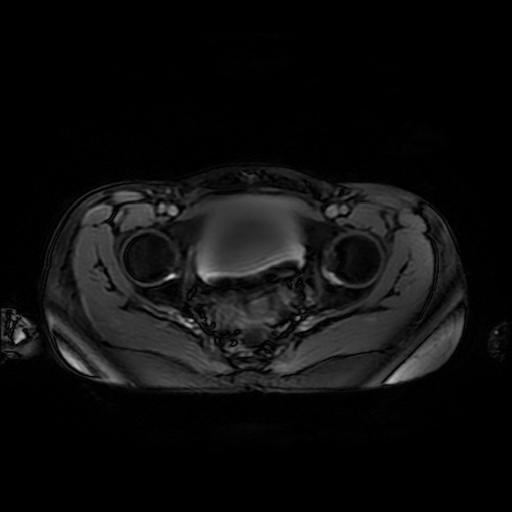File:Normal MRI abdomen in pregnancy (Radiopaedia 88001-104541 D 52).jpg