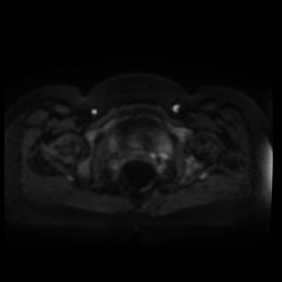 Normal MRI abdomen in pregnancy (Radiopaedia 88005-104548 Axial DWI 46).jpg