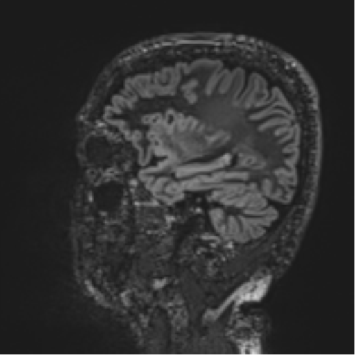 Normal brain MRI (non-focal epilepsy protocol) (Radiopaedia 53917-60040 Sagittal DIR 21).png