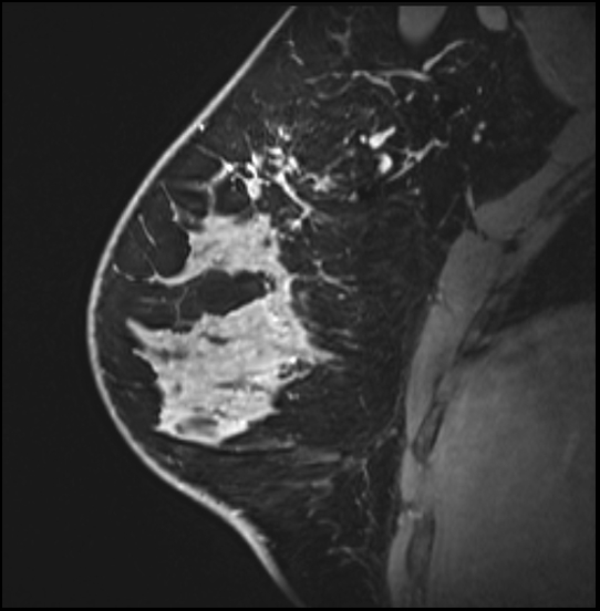 Normal breast MRI - dense breasts (Radiopaedia 80454-93850 I 62).jpg