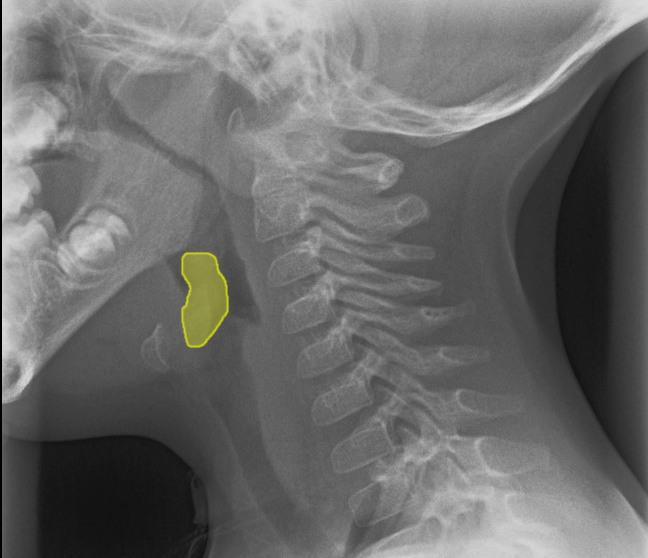 File:Normal epiglottis location (illustration) (Radiopaedia 21596).png