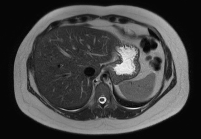 File:Normal liver MRI with Gadolinium (Radiopaedia 58913-66163 Axial T2 25).jpg