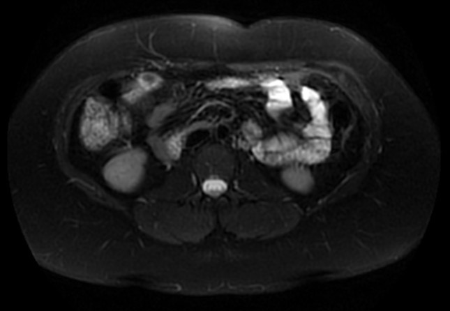 File:Normal liver MRI with Gadolinium (Radiopaedia 58913-66163 Axial T2 fat sat 13).jpg