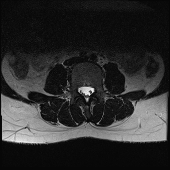 File:Normal lumbar spine MRI- 3 T (Radiopaedia 53280-59250 Axial T2 12).jpg