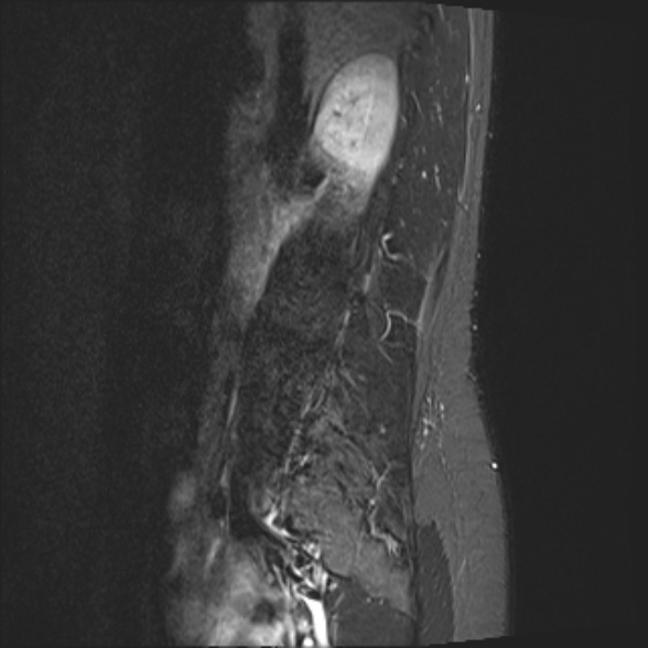 File:Normal lumbar spine MRI- 3 T (Radiopaedia 53280-59250 Sagittal STIR 3).jpg