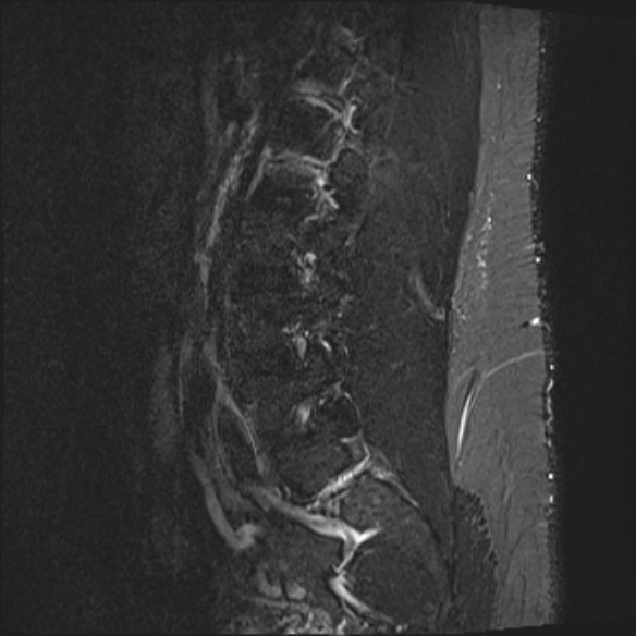 File:Normal lumbar spine MRI (Radiopaedia 47857-52609 Sagittal STIR 17).jpg
