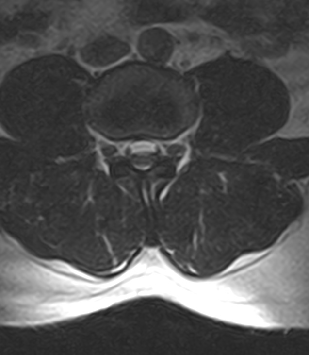 Normal lumbar spine MRI - low-field MRI scanner (Radiopaedia 40976-43699 Axial T2 58).jpg