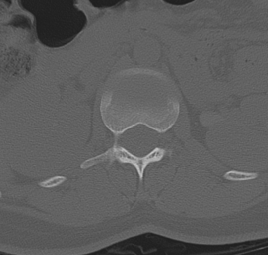 File:Normal lumbosacral CT (Radiopaedia 37923-39867 Axial bone window 33).png