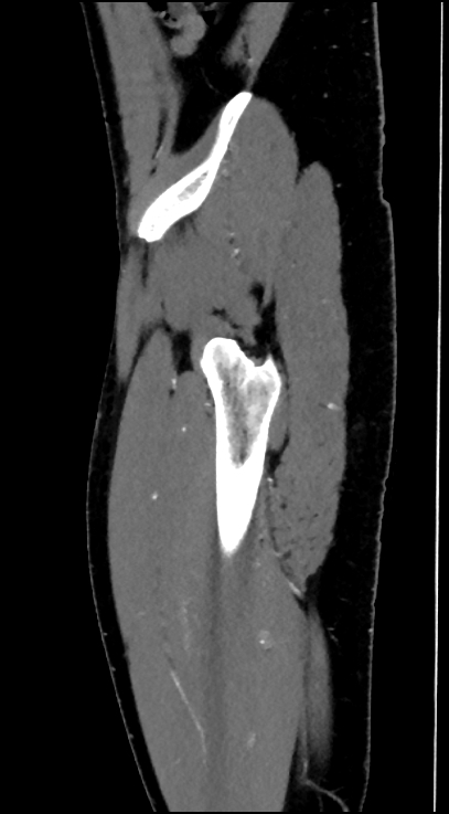 Normal pelvis CT angiogram (Radiopaedia 84966-100481 C 95).jpg