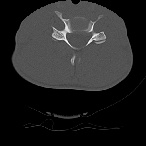 File:Normal trauma spine imaging (age 16) (Radiopaedia 45335-49358 Axial bone window 51).jpg