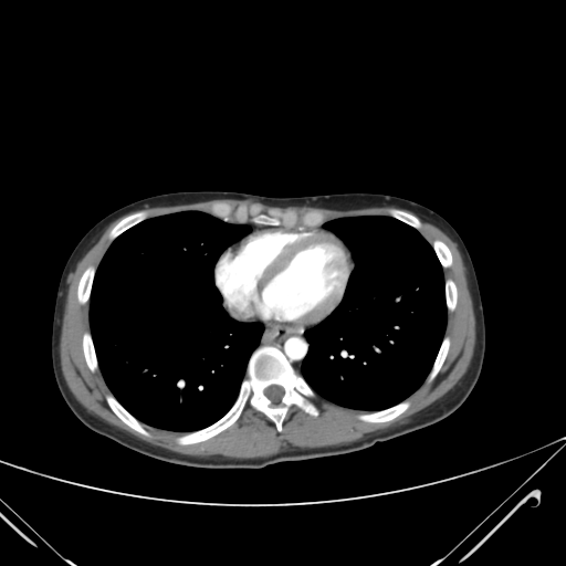 File:Nutmeg liver- Budd-Chiari syndrome (Radiopaedia 46234-50635 A 1).png