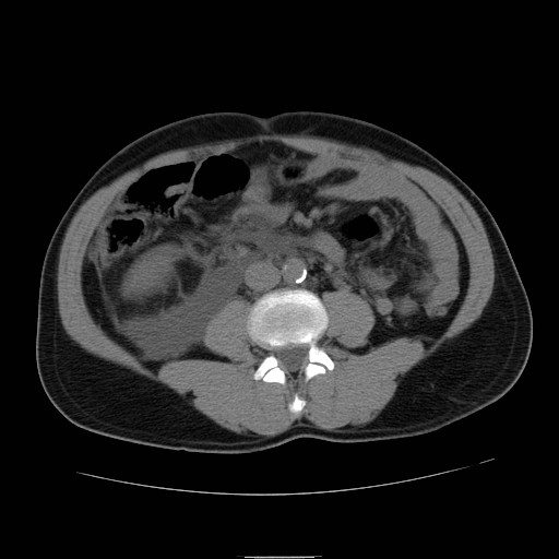 File:Obstructed kidney with perinephric urinoma (Radiopaedia 26889-27066 Axial non-contrast 33).jpg
