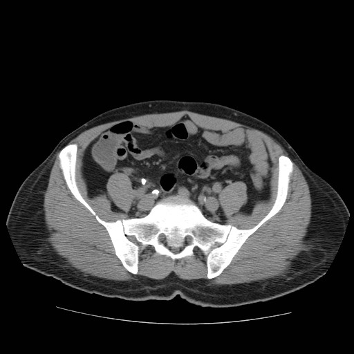 File:Obstructed kidney with perinephric urinoma (Radiopaedia 26889-27067 Axial non-contrast 33).jpg