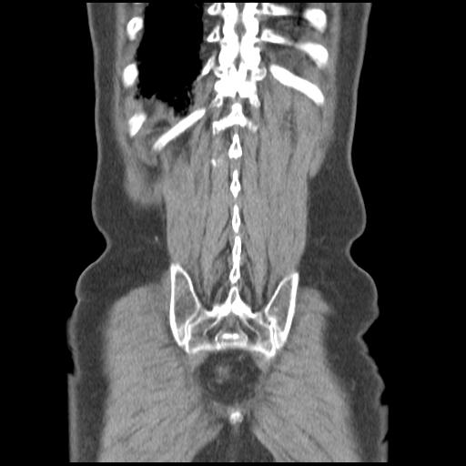 Obstructing renal calculus (Radiopaedia 29517-30016 Coronal non-contrast 46).jpg