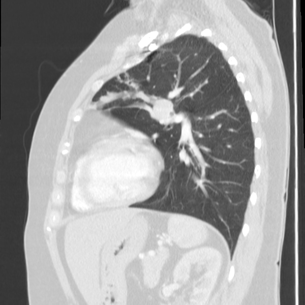 Obstructing typical carcinoid causing bronchoceles (Radiopaedia 50149-55476 Sagittal lung window 39).png
