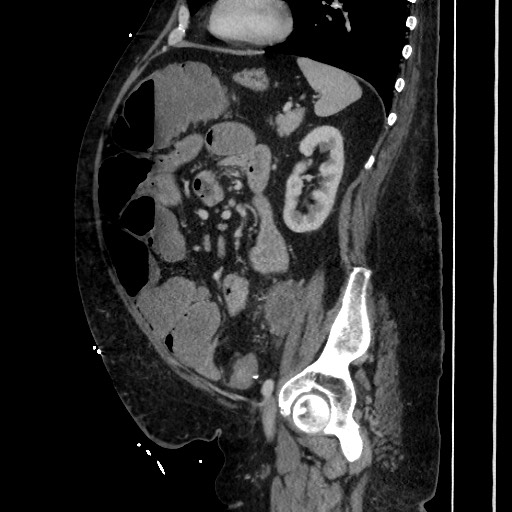 Obstructive colonic diverticular stricture (Radiopaedia 81085-94675 C 158).jpg