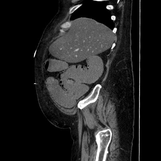 Obstructive colonic diverticular stricture (Radiopaedia 81085-94675 C 57).jpg