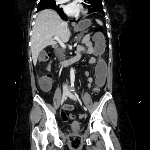 Obstructive distal colonic adenocarcinoma causing cecal perforation (Radiopaedia 86830-102989 C 101).jpg