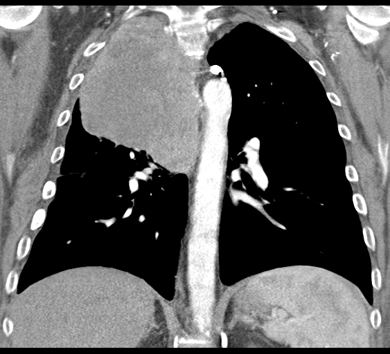 File:Obstructive superior vena cava tumor thrombus (Radiopaedia 28046-28306 B 31).jpg